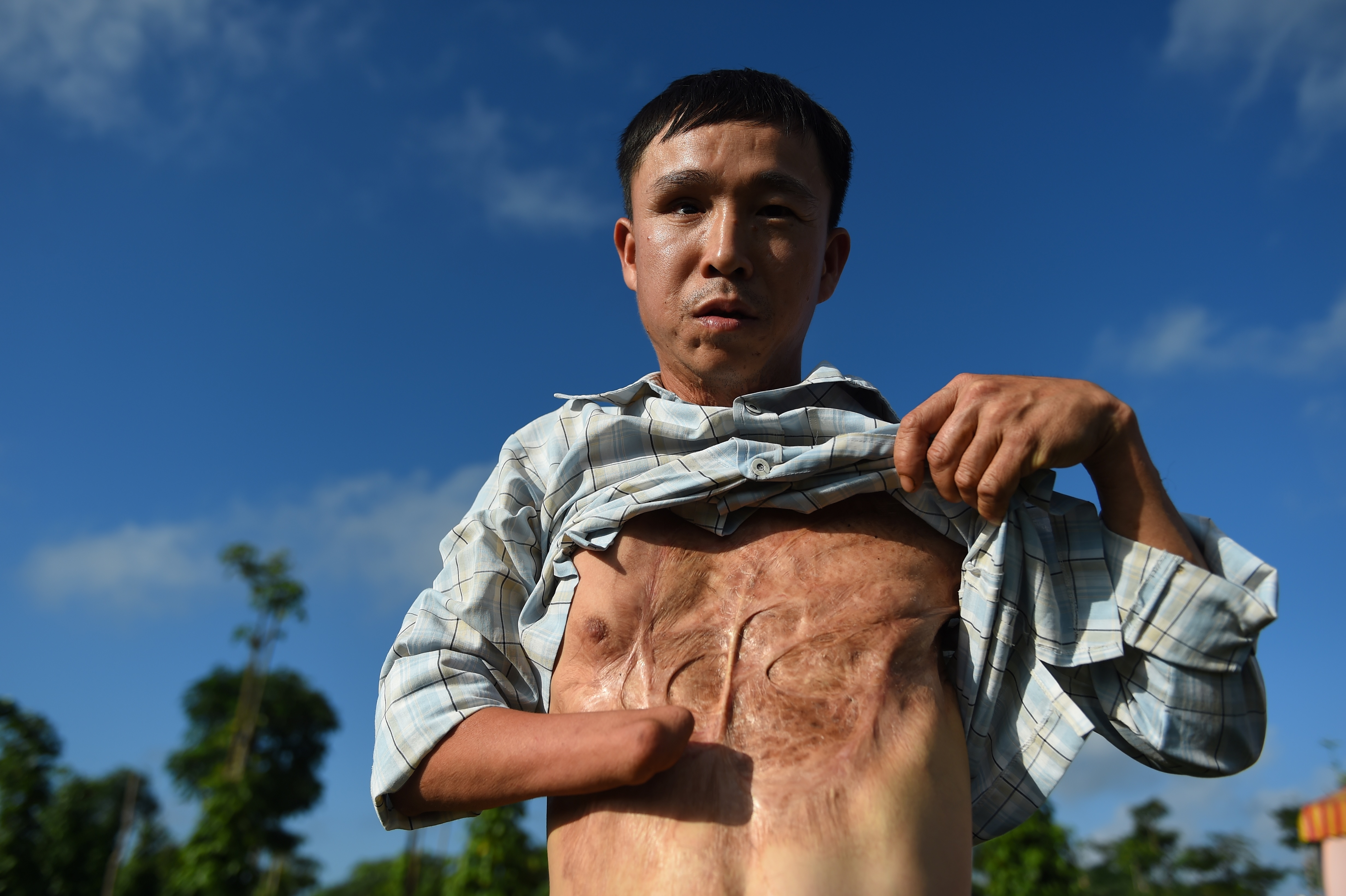 EDITORS NOTE: Graphic content / This picture taken on January 6, 2020 shows landmine victim Nguyen The Nghia displaying his wounds as a result of a munitions explosion when he was younger in Quang Tri province. - Nghia lost his hand and was nearly blinded when he was seriously injured while cleaning a school yard back in the fifth grade. At least 40,000 Vietnamese have since died in accidents related to unexploded ordnance left from the war, with victims often being farmers who accidentally trigger explosions, people salvaging scrap metal, or children who mistake bomblets for toys. (Photo by Nhac NGUYEN / AFP) / TO GO WITH Vietnam-US-weaponry-landmines,FOCUS by Tran Thi Minh Ha (Photo by NHAC NGUYEN/AFP via Getty Images)
