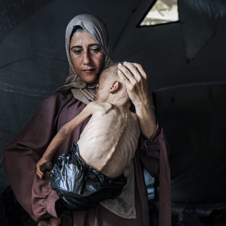 GAZA CITY, GAZA - JULY 21: Muhammad Zakariya Ayyoub al-Matouq, a 1.5-year-old child in Gaza City, Gaza, faces life-threatening malnutrition as the humanitarian situation worsens due to ongoing Israeli attacks and blockade, on July 21, 2025. Having dropped from 9 to 6 kilograms, he struggles to survive in a tent in Gaza City, where milk, food, and other basic necessities are lacking. (Photo by Ahmed Jihad Ibrahim Al-arini/Anadolu via Getty Images)